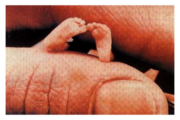Płód ludzki poddany aborcji